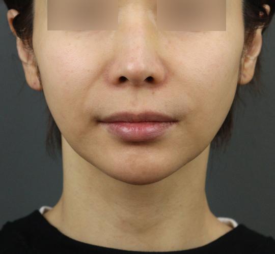 40代女性のボトックス（輪郭＆広頚筋ボトックス） Before 症例写真