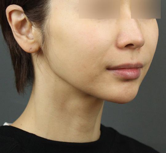 40代女性のエラ・アゴ・小顔 Before 症例写真