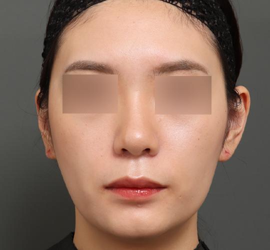 20代女性の鼻翼縮小（小鼻縮小） After 症例写真