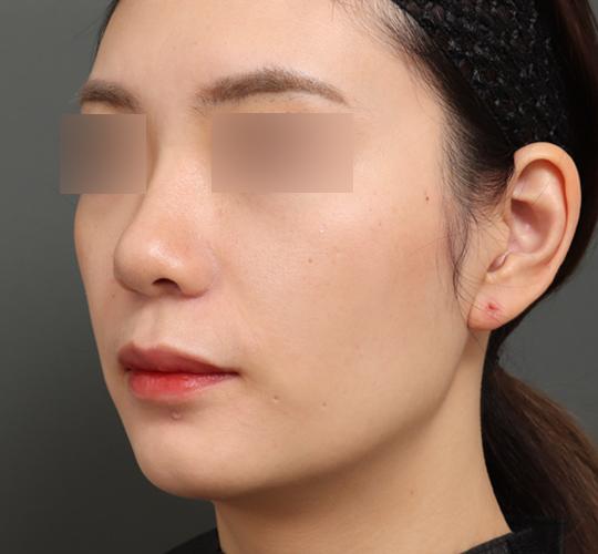 20代女性の鼻翼縮小（小鼻縮小） After 症例写真