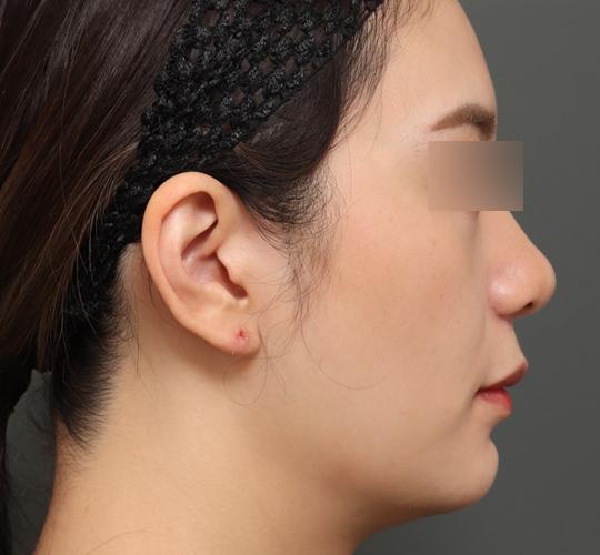 20代女性の鼻翼縮小（小鼻縮小） After 症例写真