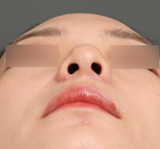 20代女性の鼻翼縮小（小鼻縮小） After 症例写真