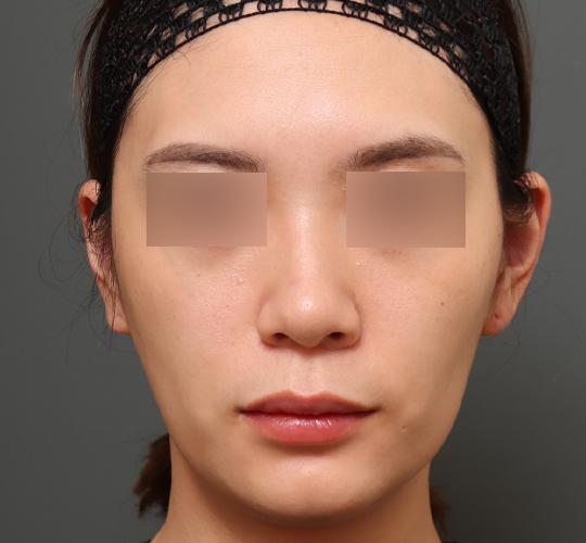 20代女性の鼻翼縮小（小鼻縮小） Before 症例写真
