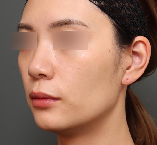 20代女性の鼻翼縮小（小鼻縮小） Before 症例写真