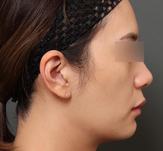 20代女性の鼻翼縮小（小鼻縮小） Before 症例写真