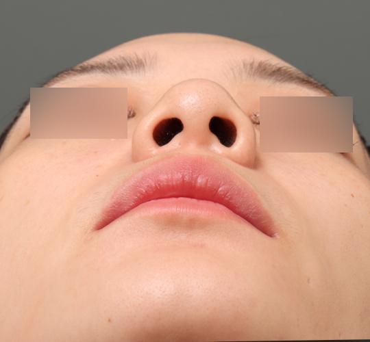 20代女性の鼻翼縮小（小鼻縮小） Before 症例写真