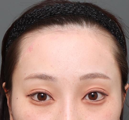20代女性の額縮小 After 症例写真