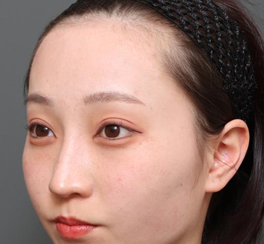 20代女性の額縮小 After 症例写真