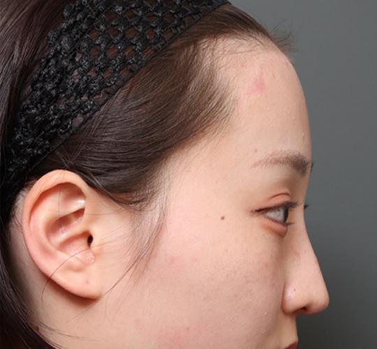 20代女性の額縮小 After 症例写真