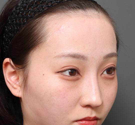 20代女性の額縮小 After 症例写真
