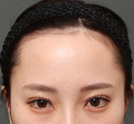 20代女性の額縮小 Before 症例写真
