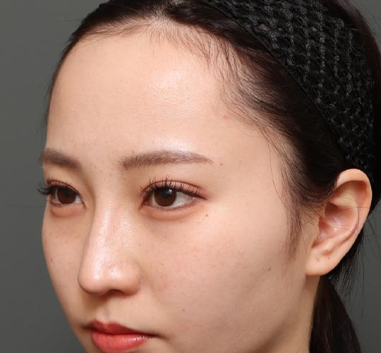 20代女性の額縮小 Before 症例写真