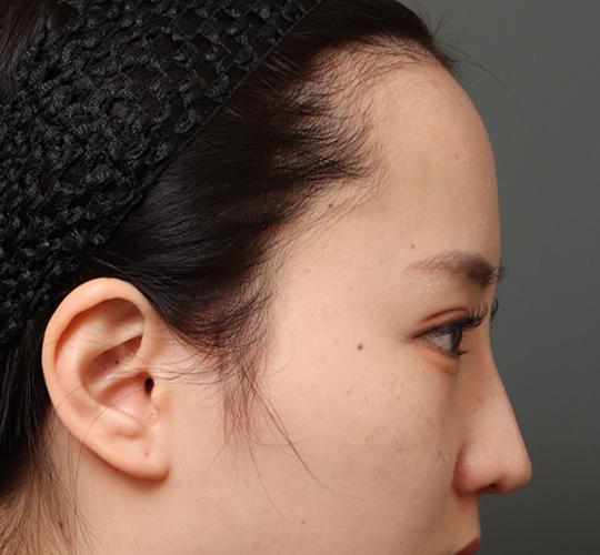 20代女性の額縮小 Before 症例写真