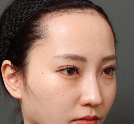 20代女性の額縮小 Before 症例写真
