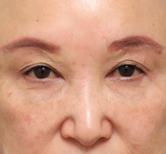 60代女性の眉下切開法 After 症例写真