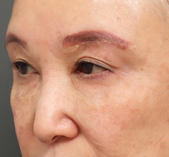 60代女性の眉下切開法 After 症例写真