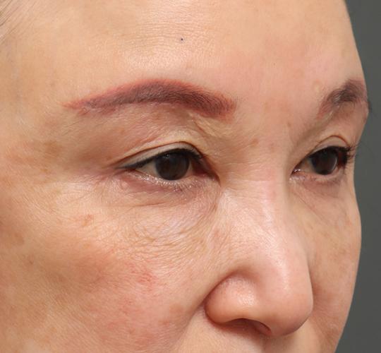60代女性の眉下切開法 After 症例写真