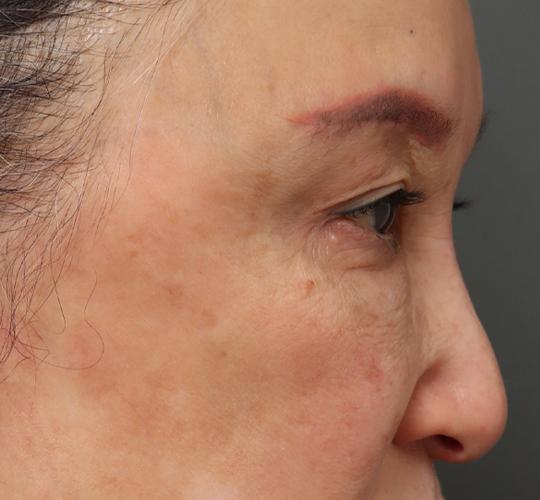 60代女性の眉下切開法 After 症例写真