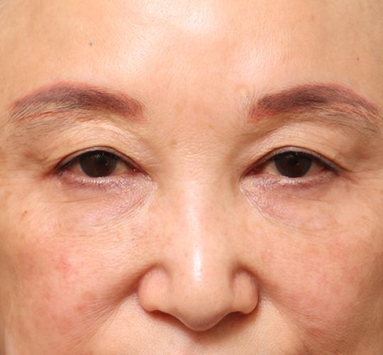 60代女性の眉下切開法 Before 症例写真
