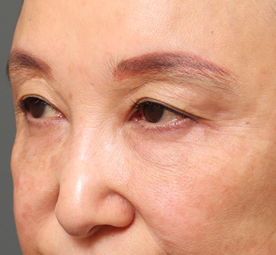 60代女性の眉下切開法 Before 症例写真