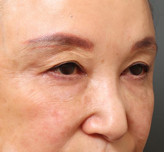 60代女性の眉下切開法 Before 症例写真