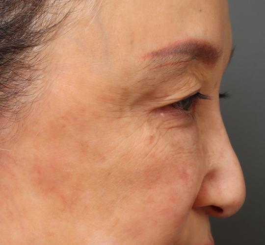 60代女性の眉下切開法 Before 症例写真