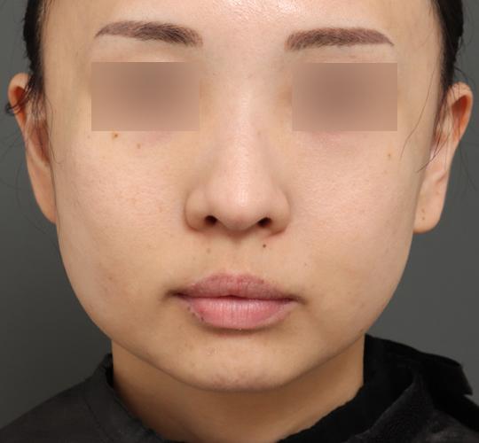 30代女性のチークリフト・フェイスリフト After 症例写真