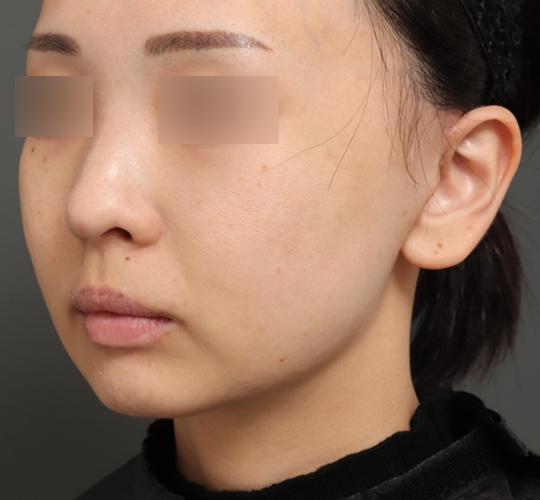 30代女性のチークリフト・フェイスリフト After 症例写真
