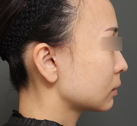 30代女性のチークリフト・フェイスリフト After 症例写真