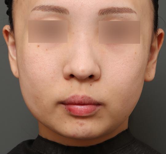 30代女性のチークリフト・フェイスリフト Before 症例写真