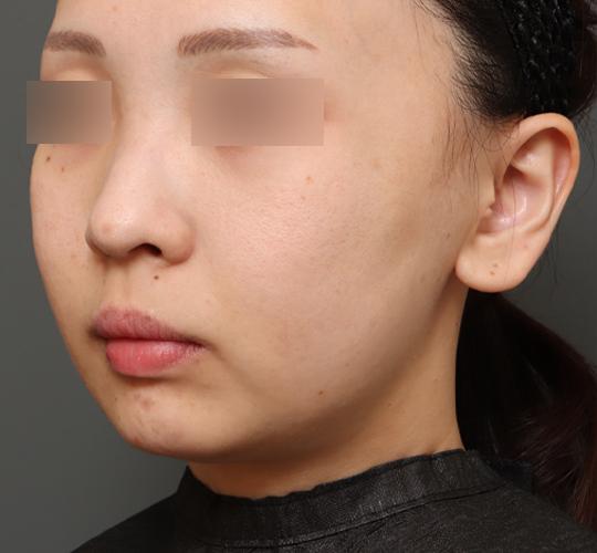 30代女性のチークリフト・フェイスリフト Before 症例写真