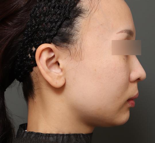 30代女性のチークリフト・フェイスリフト Before 症例写真