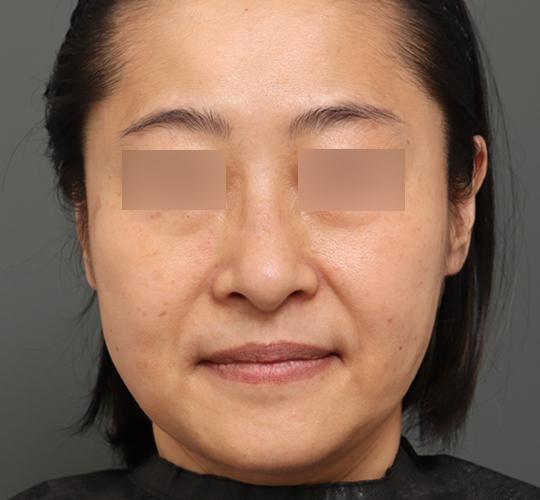 50代女性の顔の脂肪吸引  After 症例写真