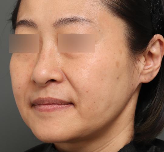 50代女性の顔の脂肪吸引  After 症例写真