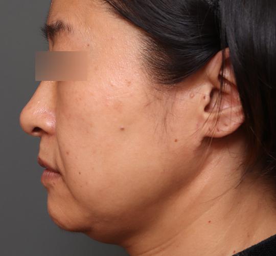 50代女性のエラ・アゴ・小顔 Before 症例写真