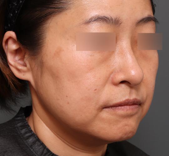 50代女性の顔の脂肪吸引  Before 症例写真