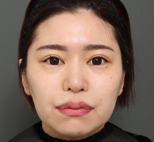 30代女性の切らない鼻スレッドリフト After 症例写真