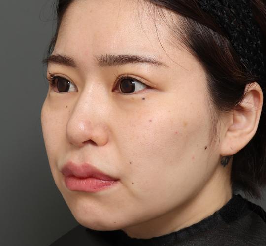 30代女性の切らない鼻スレッドリフト After 症例写真