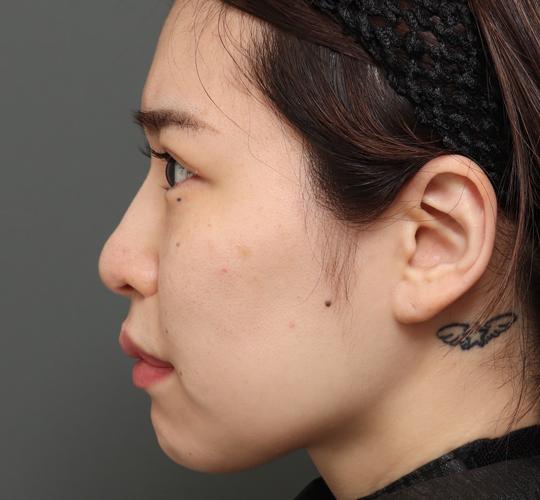 30代女性の切らない鼻スレッドリフト After 症例写真