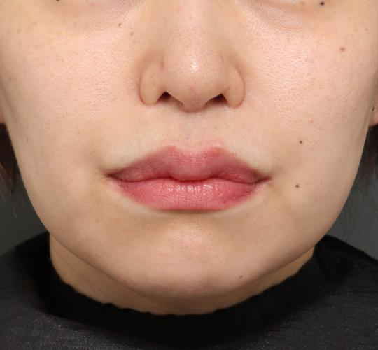 30代女性の切らない鼻スレッドリフト After 症例写真