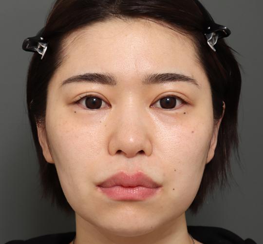 30代女性の切らない鼻スレッドリフト Before 症例写真