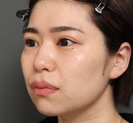 30代女性の切らない鼻スレッドリフト Before 症例写真