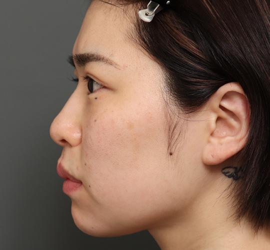 30代女性の切らない鼻スレッドリフト Before 症例写真