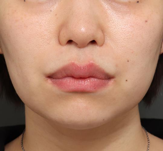 30代女性の切らない鼻スレッドリフト Before 症例写真