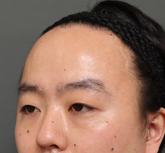 30代男性の額縮小 After 症例写真