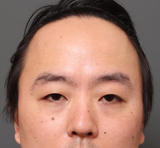 30代男性のエラ・アゴ・小顔 Before 症例写真