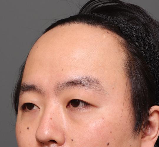 30代男性の額縮小 Before 症例写真