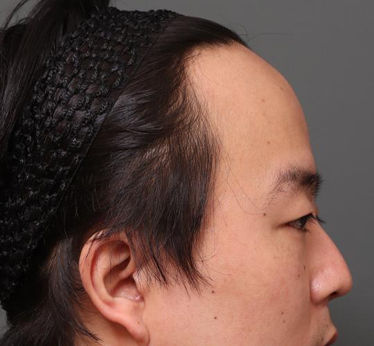 30代男性の額縮小 Before 症例写真