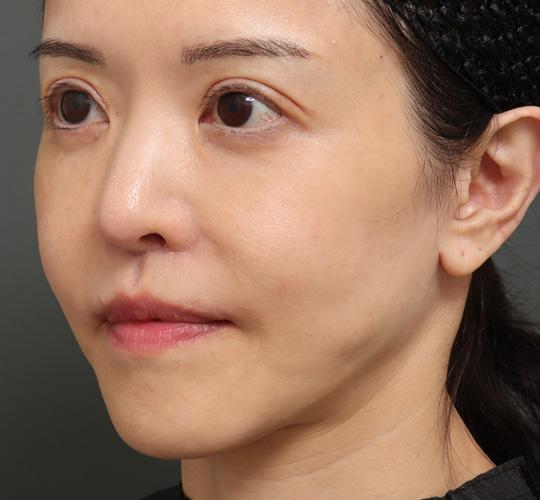 50代女性の人中短縮（リップリフト） After 症例写真