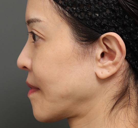 50代女性の人中短縮（リップリフト） After 症例写真